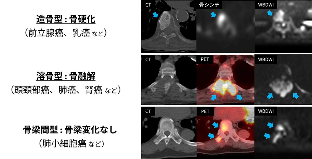 眼がんは急速に広がりますか?